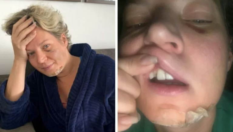 Vídeo: Joice Hasselmann acorda com fraturas no corpo, diz ...