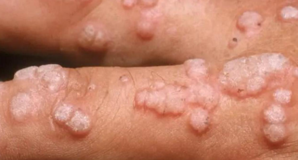 HPV em mulheres