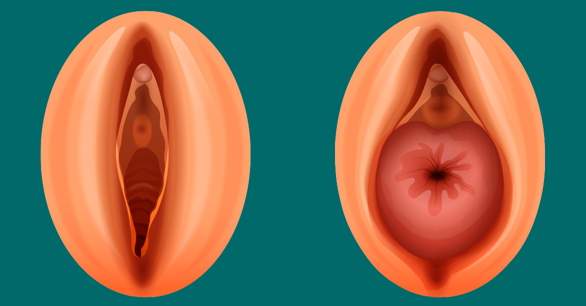 Prolapso uterino