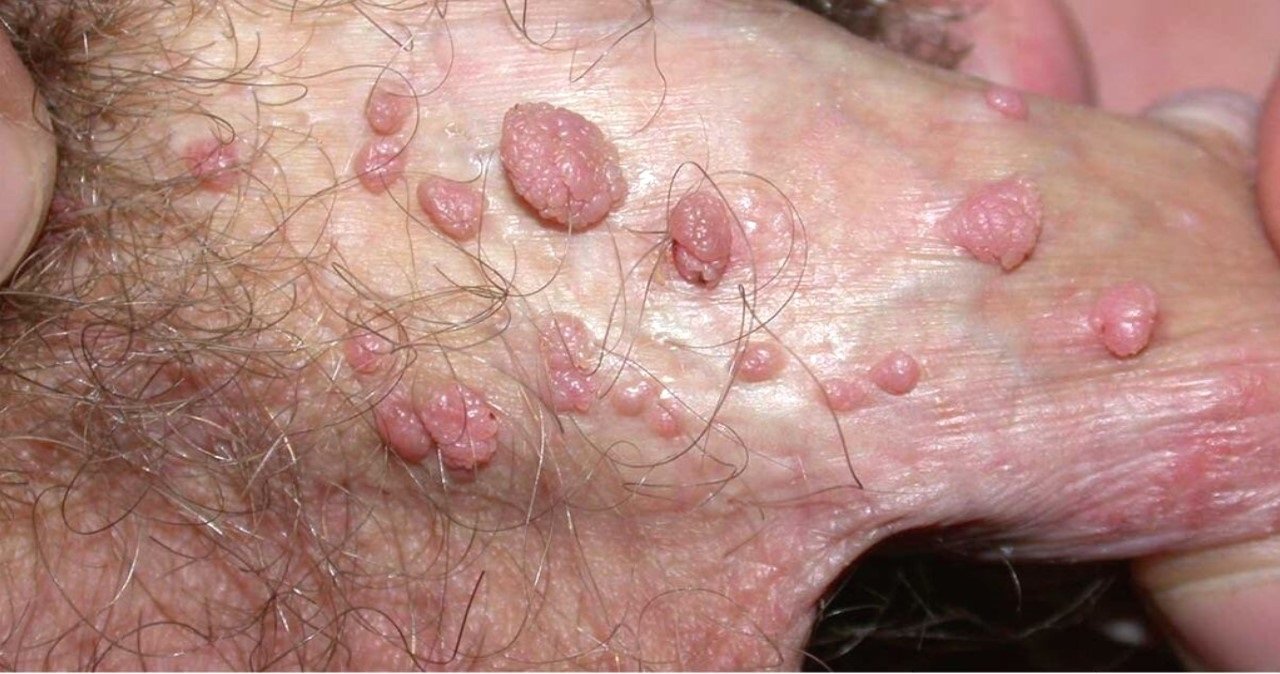 hpv