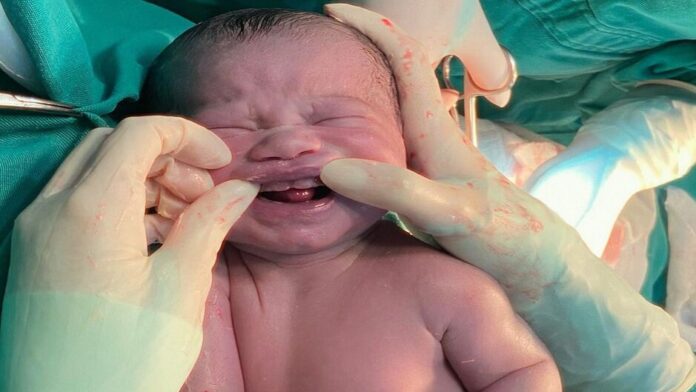 Bebê nasce com dentes de leite; caso raro surpreende família e equipe médica