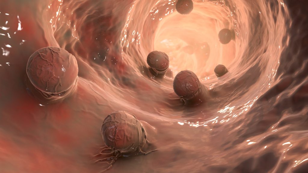 o que causa pólipo no intestino