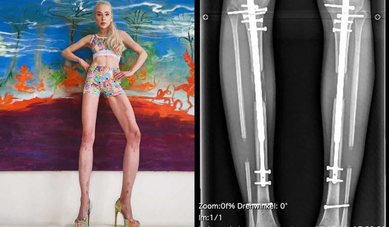 Modelo alemã enfrenta complicações graves após gastar US$ 160 mil em cirurgia de alongamento de pernas
