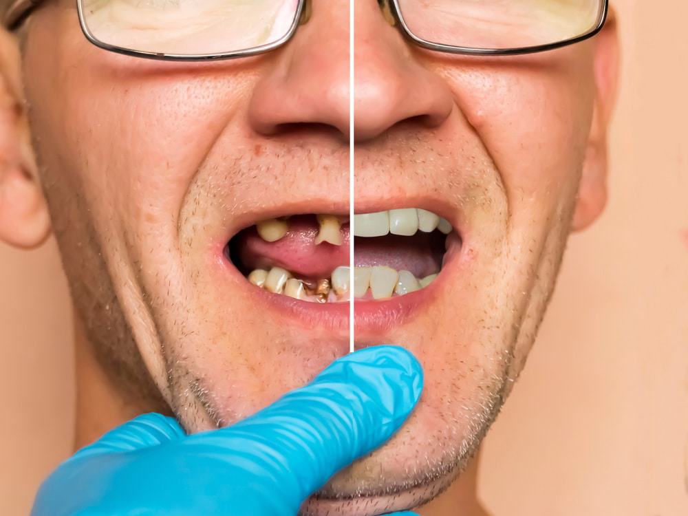 novo medicamento para regeneração de dentes