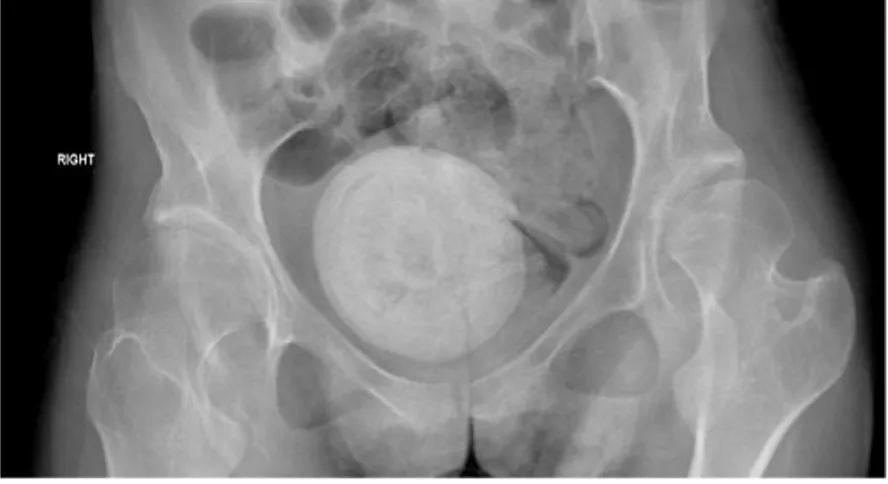 Pedra gigante é encontrada na vagina de mulher 