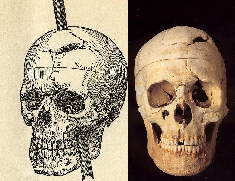 Phineas Gage