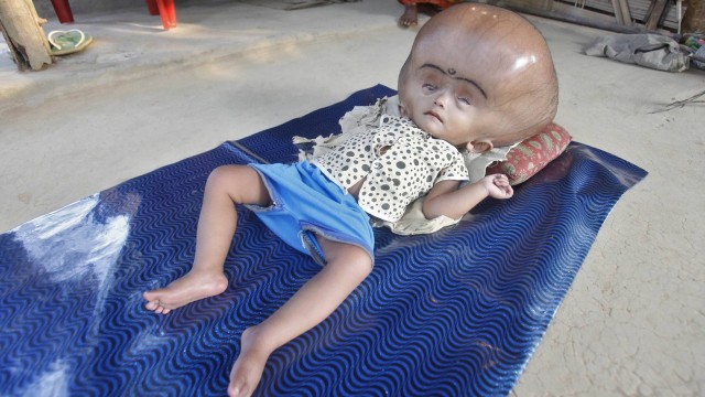 Criança com doença rara tem a cabeça gigante