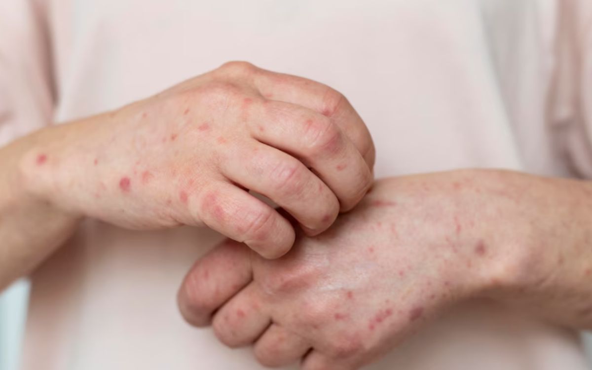 Vírus varíola: uma doença erradicada, mas com potencial de pandemia