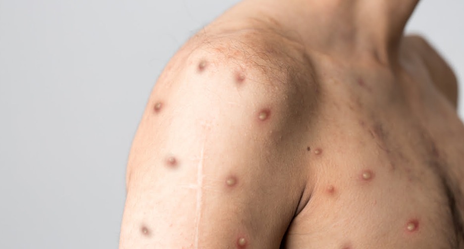 Representação visual do monitoramento de casos de mpox no Brasil pelo Ministério da Saúde.