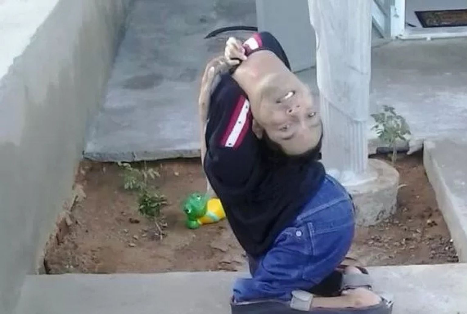 Baiano com rara deformidade diz levar vida normal 