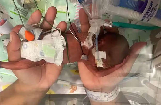 O bebê mais prematuro do mundo, inspira com sua história de superação