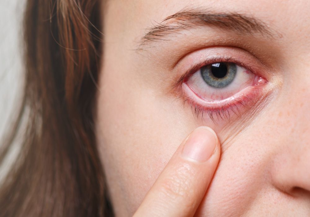 herpes ocular