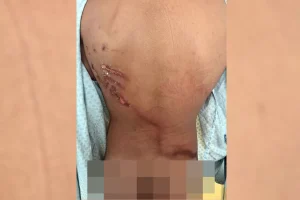 jovem edurado linhares ferido por raio em manifestação