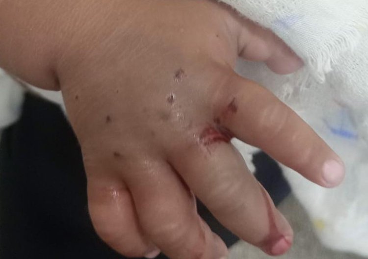 bebe de 1 ano picado por cobra dentro de casa na zona rural de maués