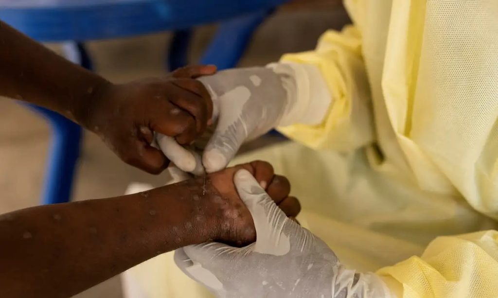detalhe de lesoes cutaneas caracteristicas do virus mpox em pessoa infectada