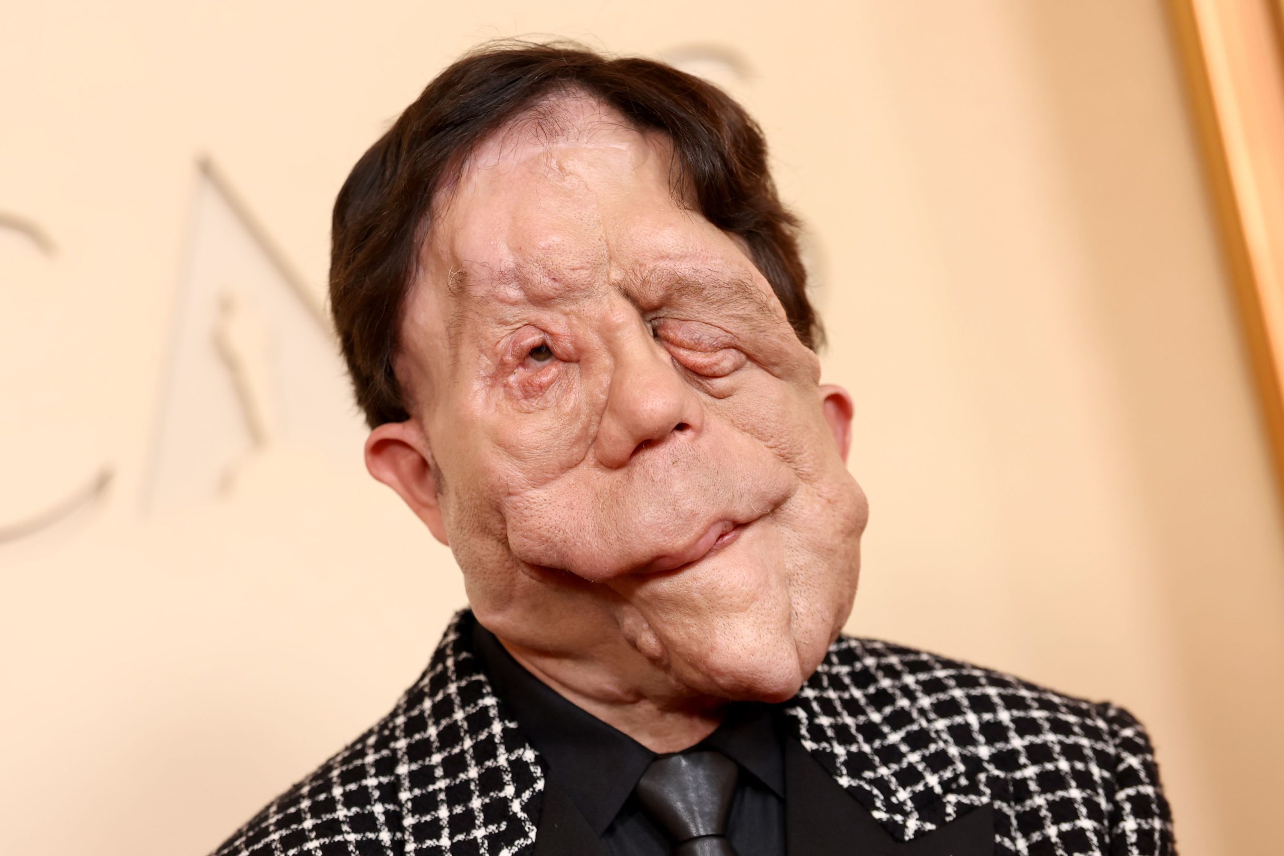 O ator Adam Pearson em destaque representando a visibilidade da neurofibromatose e conscientização sobre a doença genética.