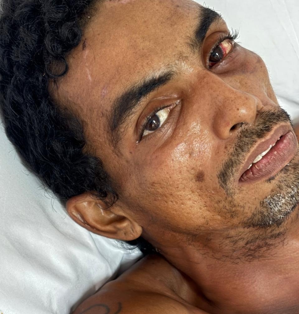 Paciente internado no Hospital João Lúcio em Manaus após sofrer choque elétrico.