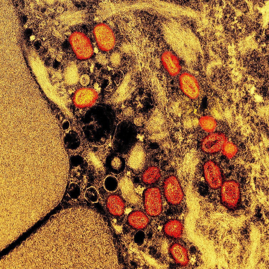 paciente com lesoes de mpox e embalagem do medicamento antiviral tecovirimat em contexto de estudo clinico
